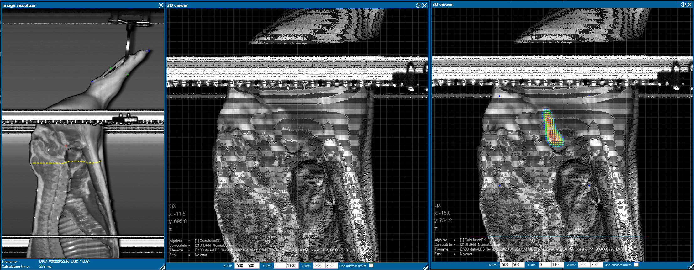 Pelvic Bone Detection